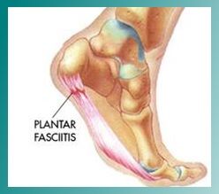 anatomia de la fascitis plantar