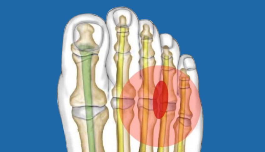neuroma de morton