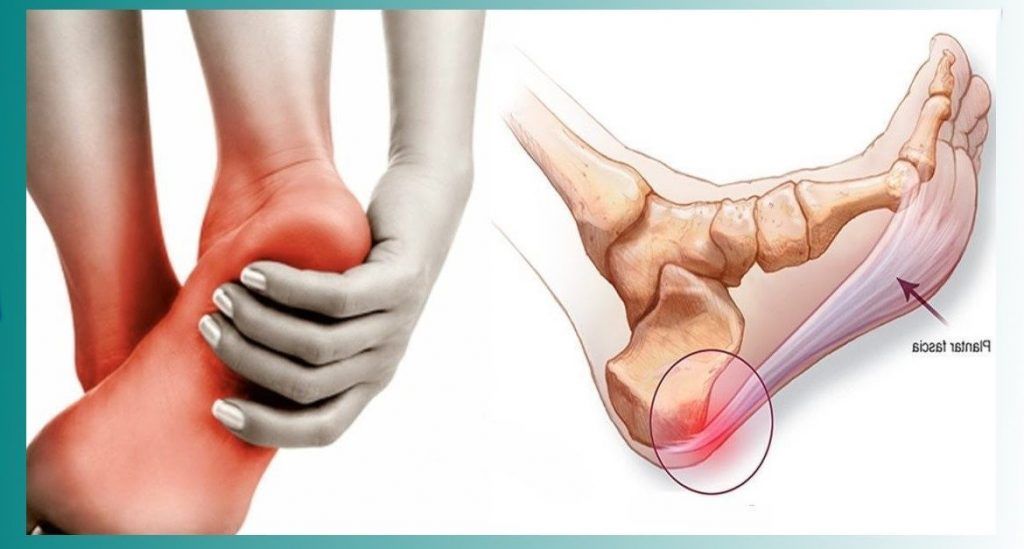 dolor de talon talalgia