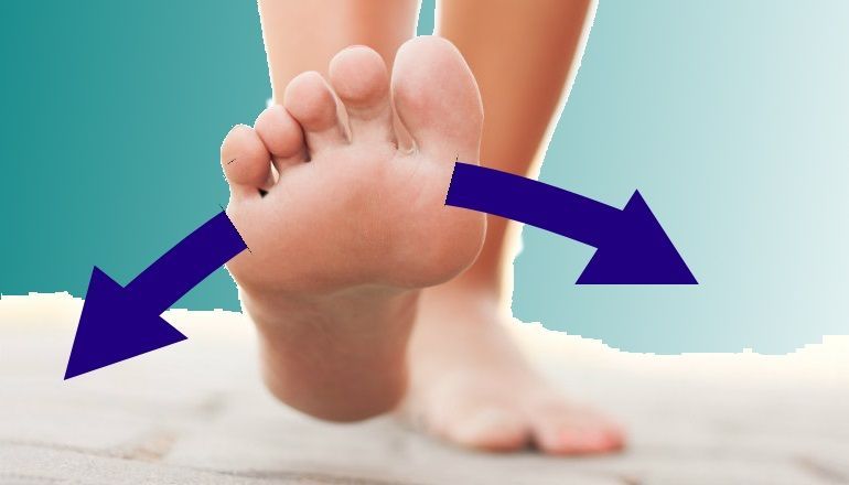 Metatarsalgia. Causas y síntomas 4 pronación supinación en la metatarsalgia
