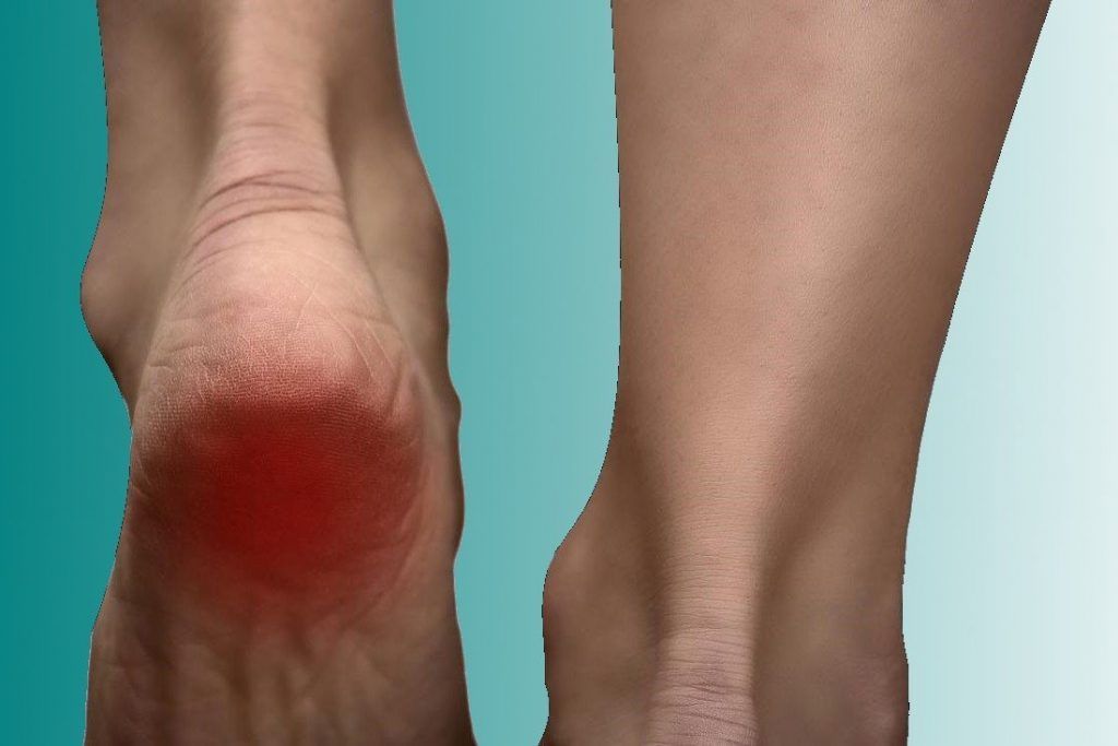 dolor en el talon