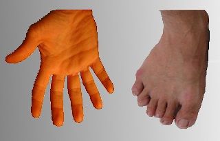 polidactilia