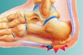 dolor espolon calcaneo del pie